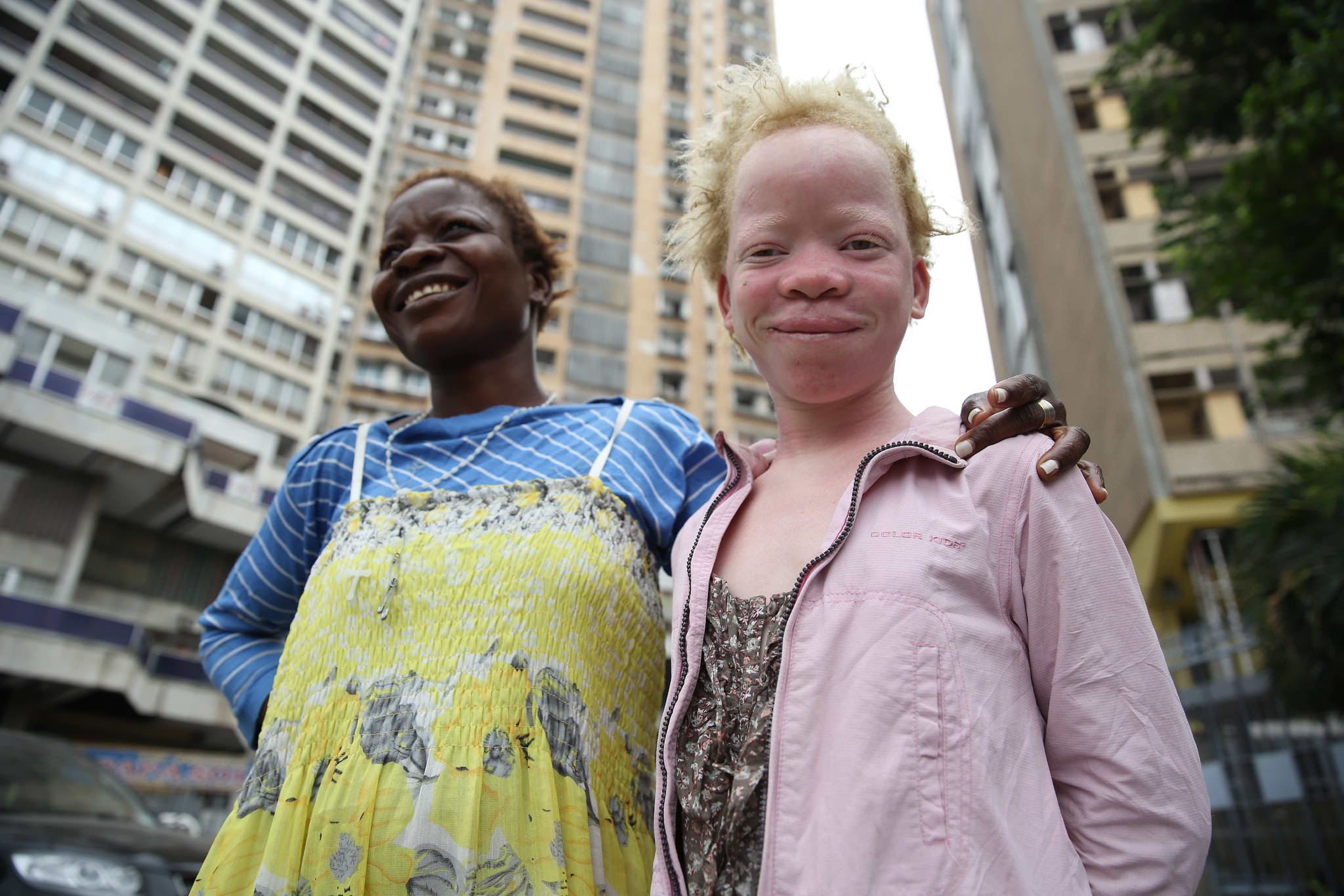 Kusitisha mashambulizi— kulinda haki za albino
